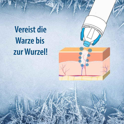 Evolsin® kārpu saldētava parastajām kārpām un vībotnēm | Kārpu sasaldēšana higiēniska un droša | Kārpu līdzeklis