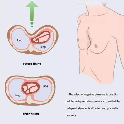 Exemic Pectus Excavatum vakuuma kauss — Pectus Excavatum ortoze, Pectus Excavatum ortoze pieaugušajiem un bērniem, mazgājama, Pectus Excavatum (LL) fiziska korekcija