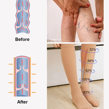 2 pāri medicīnisko kompresijas zeķu sievietēm un vīriešiem 20-30 mmHg, 2. klase, slēgtas purngala pakāpeniskas atbalsta zeķes varikozām vēnām, tūskai un vēnām (2x bēšas, L)