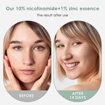 Niacinamīds 10% + cinks 1% 30ml, seruma hialuronskābes serums pret grumbām sejas serums, mitrinošs sejas ādas kopšanas serums, mitrinošs sejas serums