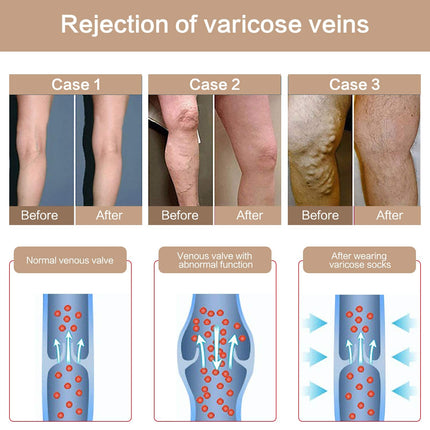 YISEMEYA 2 pāru medicīniskās kompresijas zeķes sievietēm, garas, 20-30 mmHg atbalsta zeķes sievietēm, necaurspīdīgas pirkstu aptinuma kompresijas zeķubikses sievietēm, lielisks atbalsts varikozām vēnām, tūska